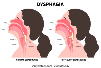 Difficulty swallowing of Dysphagia disorder with cough choking when eating food