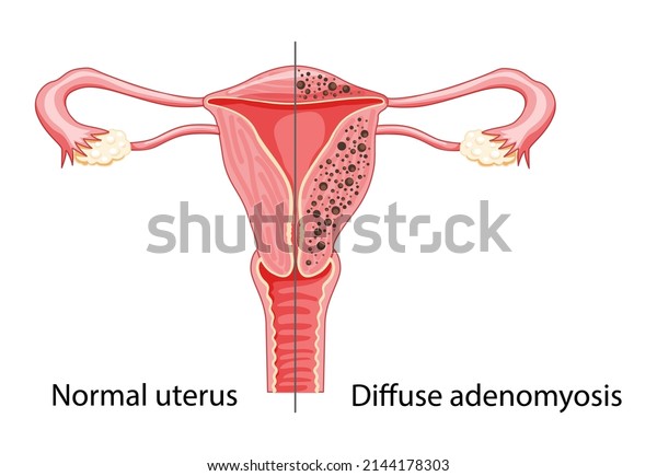 Diffuse Adenomyosis Human anatomy Female\
reproductive Sick system vs versus normal. Compared educational\
healthy and abnormal anatomy organs uterus icon flat cartoon vector\
illustration isolated