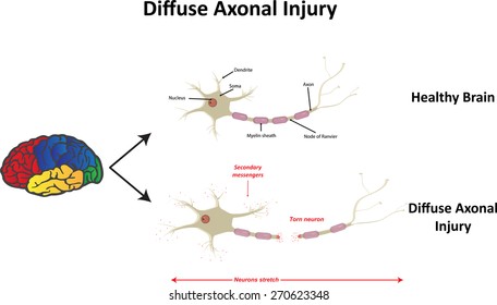 Diffuse Axonal Injury 