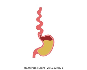 Diffuse Esophageal Spasm Clip Art