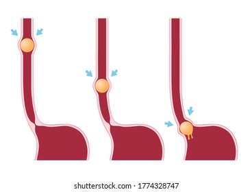 Digestion and Peristalsis vector / intestine on white