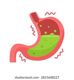 Digestive system problem A graphic illustration of an inflamed stomach suffering from acid reflux or indigestion.