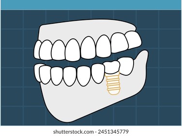 digital view for 3d Scanner model of tooth and dental implant - flat illustration   