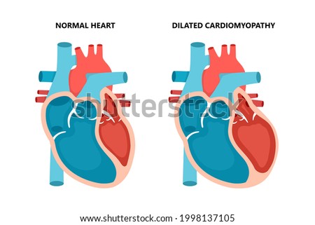 Dilated cardiomyopathy with cross-section view. Human heart muscle diseases. Cardiology concept.