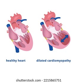 verdünnte Kardiomyopathie. Erweiterung des Herzkreises. Medizinisches Poster, Vektorgrafik