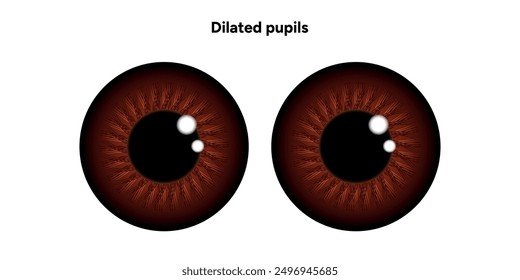 Dilated pupils eye diseases ophthalmology