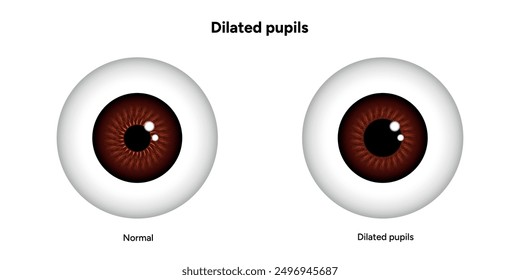 Dilated pupils eye diseases ophthalmology