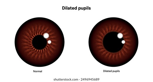 Dilated pupils eye diseases ophthalmology