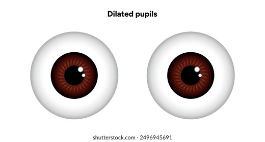 Dilated pupils eye diseases ophthalmology