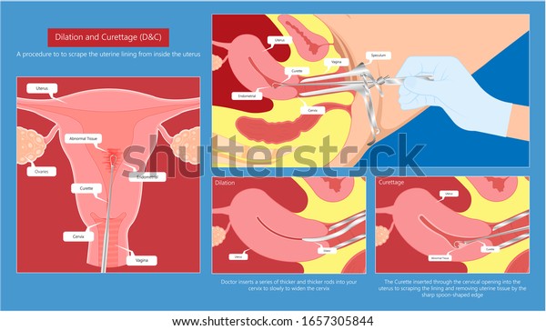 Dilation and curettage D&C diagnostic treat\
uterine heavy exam biopsy lab cancerous therapy molar pregnant\
hysteroscope screen wall labor cycles medical pap surgery loss\
ectopic neonatal missed\
period