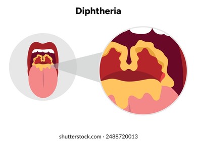 Diphtheria open mouth illustration with throat zoom and bacterial 