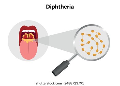 Diphtherie-Illustration mit offenem Mund mit Rachenzoom und Bakterien 