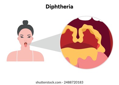 Ilustración de la boca abierta de la mujer de la difteria con la garganta y el zoom bacteriano