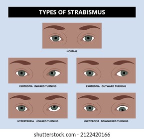 Diplopia Double Vision Test Exam Brain Nerve Dry Eye Palsy Gravis Muscle Loss Head Brain Tumor Squint Ptosis Gaze Myopia Miosis Tropia Phoria Maddox Rod Horner's Ocular Amblyopia Lazy Stroke Abducens