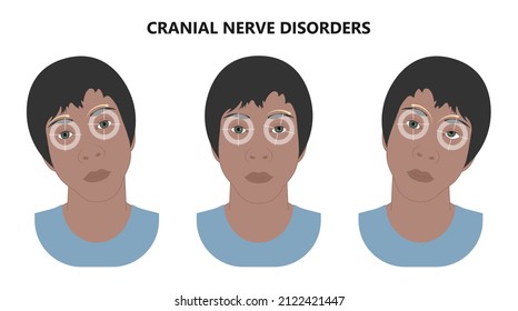 Diplopia double vision test exam brain nerve dry eye palsy gravis muscle loss head brain tumor squint ptosis gaze myopia miosis tropia Phoria maddox rod horner's ocular amblyopia Lazy stroke abducens