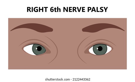 Diplopia double vision test exam brain nerve dry eye palsy gravis muscle loss head brain tumor squint ptosis gaze myopia miosis tropia Phoria maddox rod horner's ocular amblyopia Lazy stroke abducens