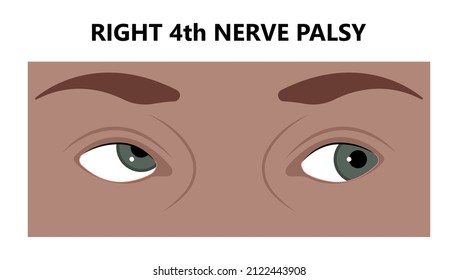 Diplopia double vision test exam brain nerve dry eye palsy gravis muscle loss head brain tumor squint ptosis gaze myopia miosis tropia Phoria maddox rod horner's ocular amblyopia Lazy stroke abducens