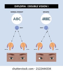 Diplopia double vision test exam brain nerve dry eye palsy gravis muscle loss head brain tumor squint ptosis gaze myopia miosis tropia Phoria maddox rod horner's ocular amblyopia Lazy stroke abducens