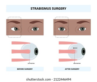 Diplopia Double Vision Test Exam Brain Nerve Dry Eye Palsy Gravis Muscle Loss Head Brain Tumor Squint Ptosis Gaze Myopia Miosis Tropia Phoria Maddox Rod Horner's Ocular Amblyopia Lazy Stroke Abducens