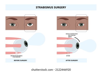 Diplopia double vision test exam brain nerve dry eye palsy gravis muscle loss head brain tumor squint ptosis gaze myopia miosis tropia Phoria maddox rod horner's ocular amblyopia Lazy stroke abducens