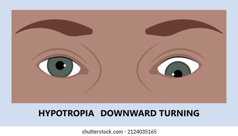 Diplopia double vision test exam brain nerve dry eye palsy gravis muscle loss head brain tumor squint ptosis gaze myopia miosis tropia Phoria maddox rod horner's ocular amblyopia Lazy stroke abducens