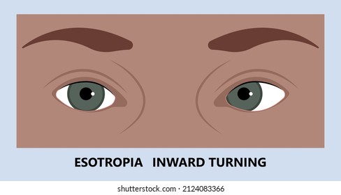 Diplopia double vision test exam brain nerve dry eye palsy gravis muscle loss head brain tumor squint ptosis gaze myopia miosis tropia Phoria maddox rod horner's ocular amblyopia Lazy stroke abducens