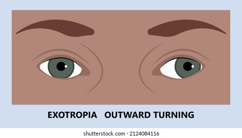 Diplopia double vision test exam brain nerve dry eye palsy gravis muscle loss head brain tumor squint ptosis gaze myopia miosis tropia Phoria maddox rod horner's ocular amblyopia Lazy stroke abducens