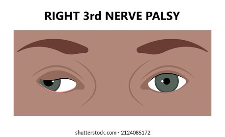 Diplopia double vision test exam brain nerve dry eye palsy gravis muscle loss head brain tumor squint ptosis gaze myopia miosis tropia Phoria maddox rod horner's ocular amblyopia Lazy stroke abducens