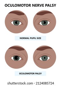 Diplopia Double Vision Test Exam Brain Nerve Dry Eye Palsy Gravis Muscle Loss Head Brain Tumor Squint Ptosis Gaze Myopia Miosis Tropia Phoria Maddox Rod Horner's Ocular Amblyopia Lazy Stroke Abducens