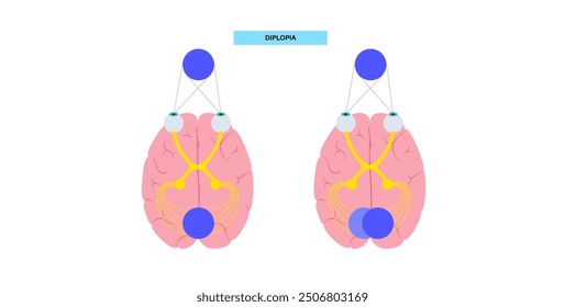 Cartel médico de Diplopia. Enfermedad de la visión doble, debilidad del músculo ocular o daño a los nervios. Percepción simultánea de dos Imágenes de un solo objeto. Conexión con el cerebro humano y la Ilustración vectorial ocular