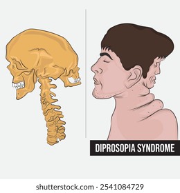 Diprosopus is a rare and life-threatening developmental defect during embryogenesis.