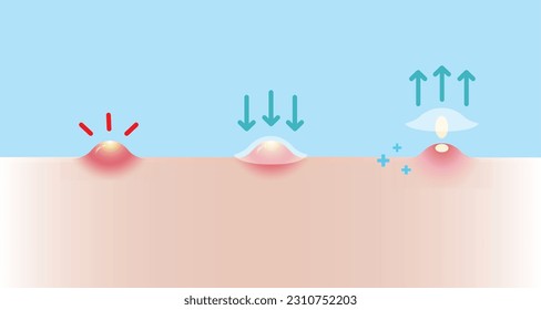 Direction for use acne pimple patch for inflammatory acne vector illustration on blue sky background. How to use, step of use acne patch absorbing pustule on skin face. Skin care and beauty concept.