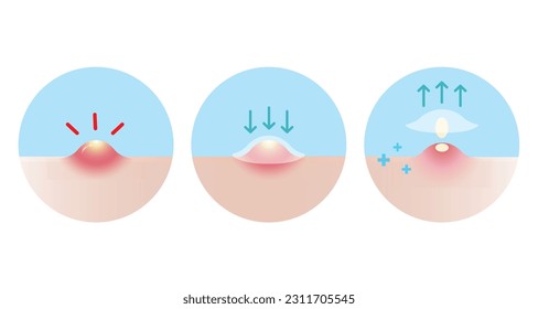 Direction for use acne pimple patch for inflammatory acne vector icon set illustration on white background. How to use, step for use acne patch absorbing pustule on skin face. Skin care concept.