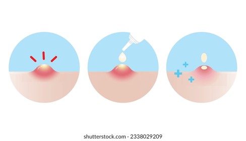 Direction for use acne pimple treatment for inflammatory acne vector icon set illustration on white background. How to use, step for use acne cream, gel and lotion absorbing pustule on skin face.