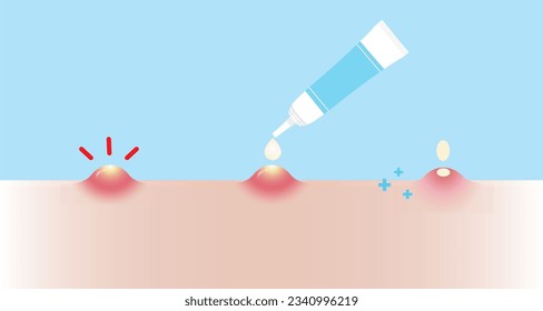 Dirección para el tratamiento del acné pimple para la ilustración del vector pustule sobre fondo azul celeste. Cómo usar, escalar para usar crema de acné, gel y loción absorbiendo acné inflamatorio en la cara de la piel.