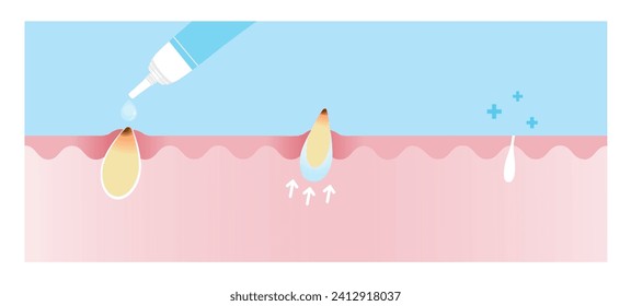 Direction for use blackhead treatment gel vector illustration on sky blue background. Cross section of use acne cream, reduce clogged pore, non inflammatory acne and tighten pore. Skin care concept.