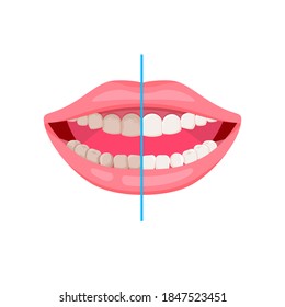 Dirty and clean teeth. Teeth cleaning and oral hygiene concept. Open mouth. Vector icon about dental care, how to brush teeth.