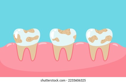 Dirty teeth are not maintained. Unhealthy teeth.