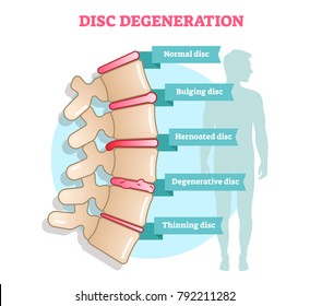 Disc degeneration flat illustration vector diagram with condition exampes - bulging, hernoated, degenerative and thinning disc. Educational medical information.
