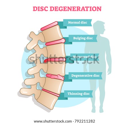 Disc degeneration flat illustration vector diagram with condition exampes - bulging, hernoated, degenerative and thinning disc. Educational medical information.
 Stock photo © 