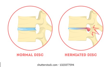 Disc Degeneration. Human Anatomy. Spine Problem. Healthy Joint And Herniated Disc. Arthritis Or Another Spinal Disease. Isolated Vector Illustration In Cartoon Style