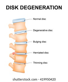 Disc degeneration it's the normal wear and tear process of aging spine. intervertebral discs lose their flexibility, elasticity, and shock-absorbing characteristics.