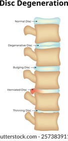 Disc Degeneration Science Design Vector Illustration Diagram