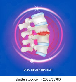 Disc degeneration spine diseases. Intervertebral discs and bones. Human vertebrae anatomy. Medical flat 3D vector illustration