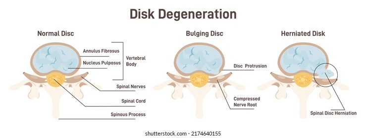 Disc degeneration stages set. flat Spine vertebrae anatomy scheme, healthy lumbar and medical conditions - bulging and herniated disc. Educational medical information. Flat vector illustration