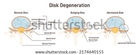 Disc degeneration stages set. flat Spine vertebrae anatomy scheme, healthy lumbar and medical conditions - bulging and herniated disc. Educational medical information. Flat vector illustration Stock photo © 
