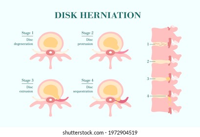 Disc herhetation, four stages and side view of spinal column