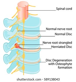 Disc herniation at a human vertebral column