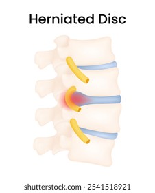 Síntomas y causas de la hernia discal