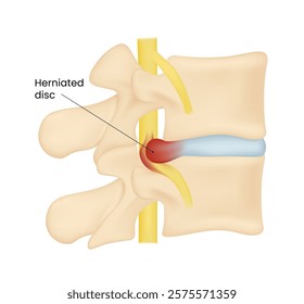 Disc Herniation Symptoms and Causes